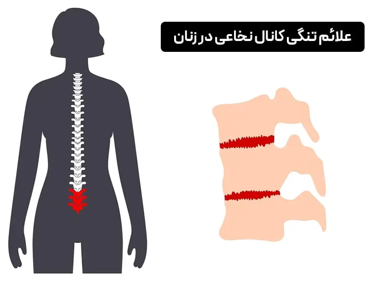 علائم تنگی کانال نخاعی در زنان