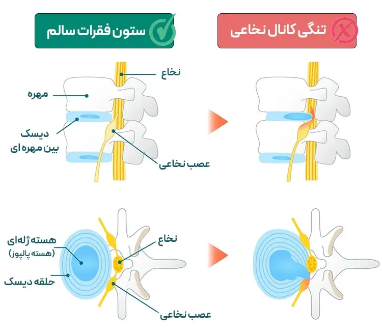 تنگی کانال نخاعی کمر (ستون فقرات)