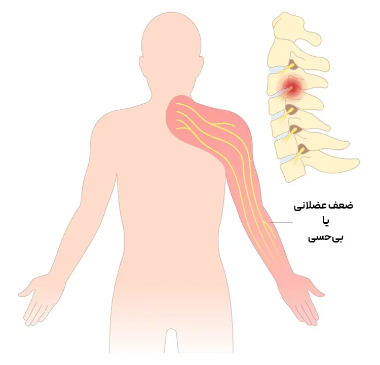 دیسک گردن و درد دست‌ها