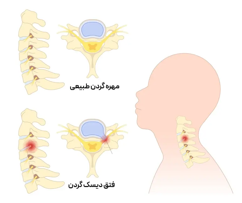 دیسک گردن