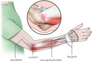 پاتوفیزیولوژی تنیس البو